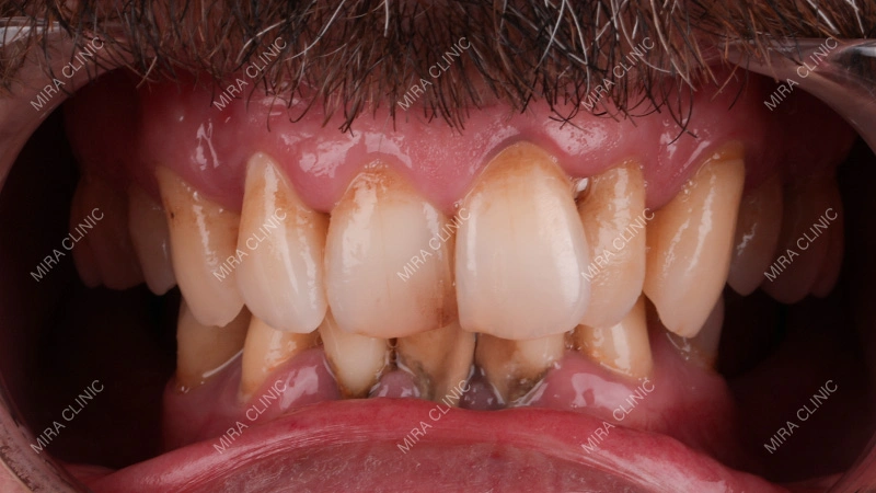 Before Treatment